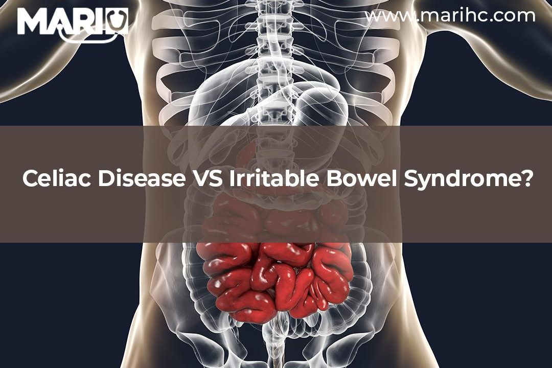 Misdiagnosis of Irritable bowel syndrome vs. Celiac disease