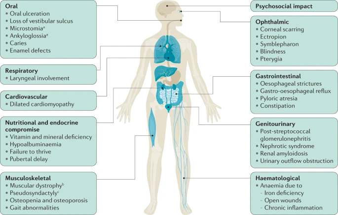 Epidermolysis Bullosa (EB)