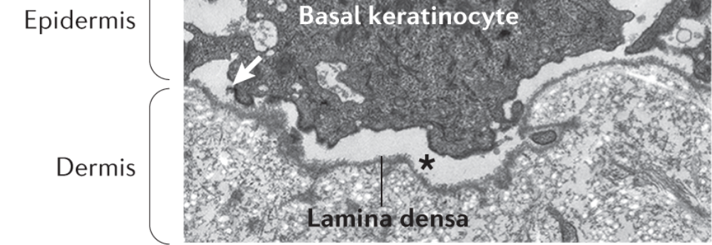 Junctional EB