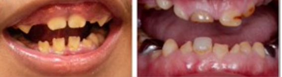 Dental enamel defects and discoloured, pitted teeth are common features