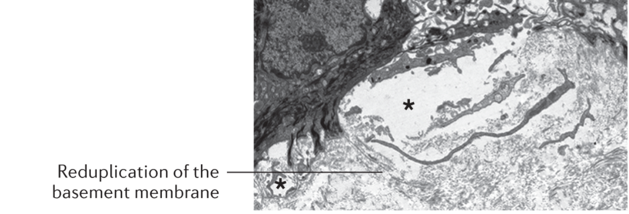 Dystrophic EB TEM features