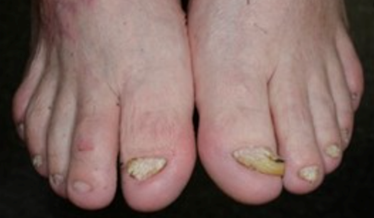 Nail abnormalities or loss