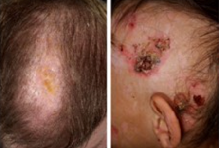 Scarring and nonscarring alopecia, resulting in patchily sparse hair