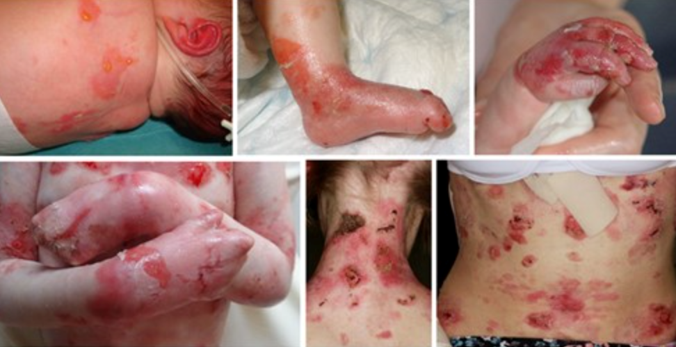 Severe recessive dystrophic epidermolysis bullosa symptoms and clinical diagnosis